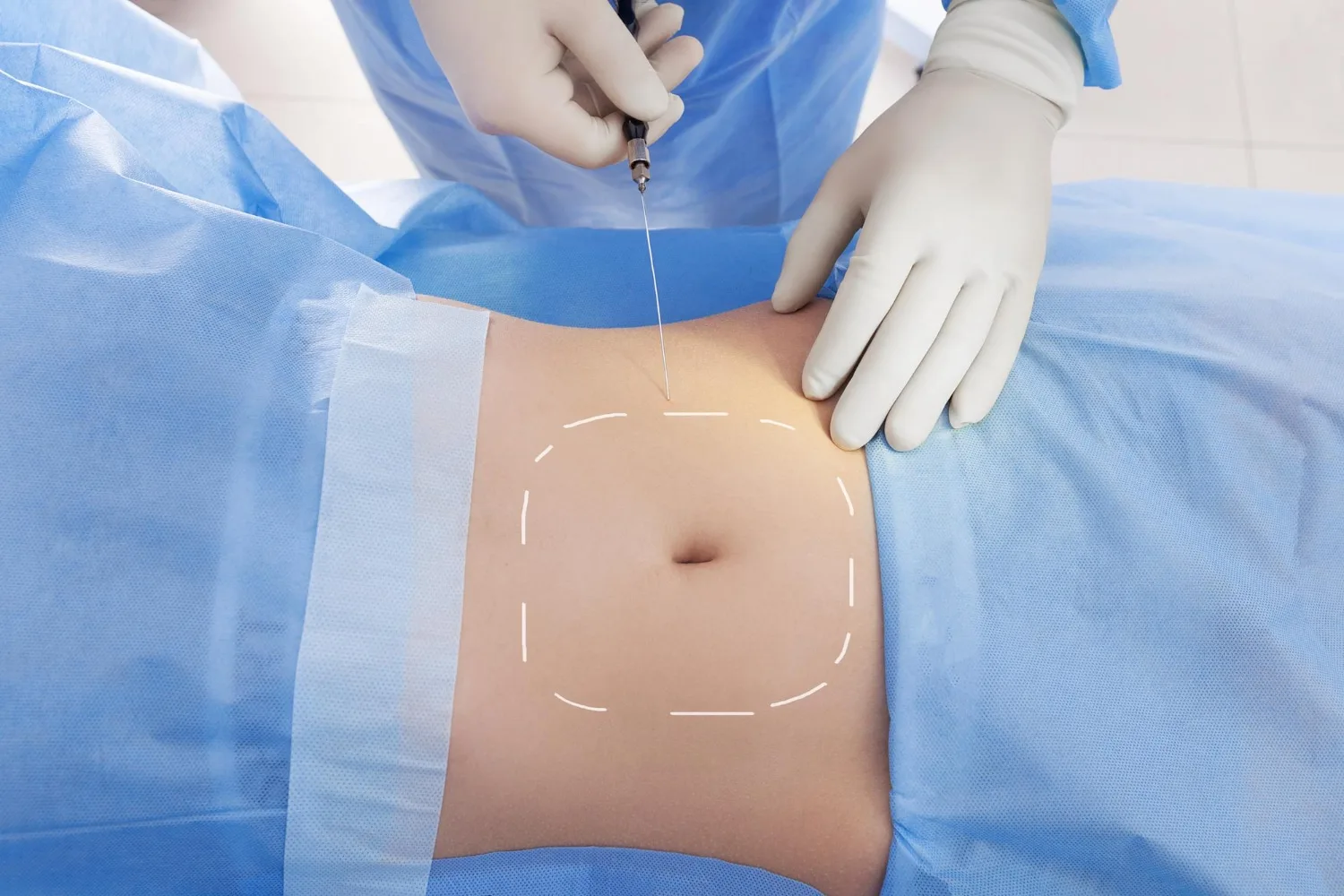 Consultation avec un chirurgien pour évaluer les conditions de prise en charge d’une abdominoplastie en France.